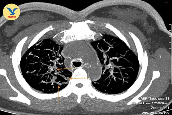 Dị dạng mạch phổi - tình cờ phát hiện nhờ khám sức khỏe định kỳ